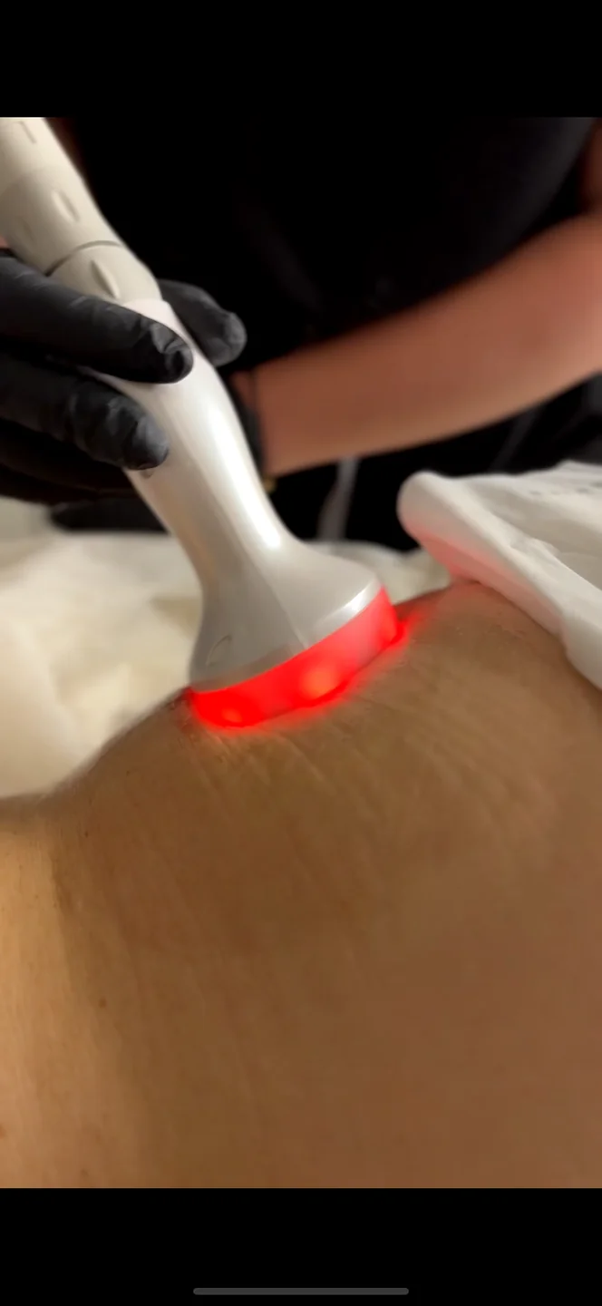 Morpheus8 Burst Body treatment at FACE Weybridge
